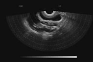 foetus at 11 wks gestation